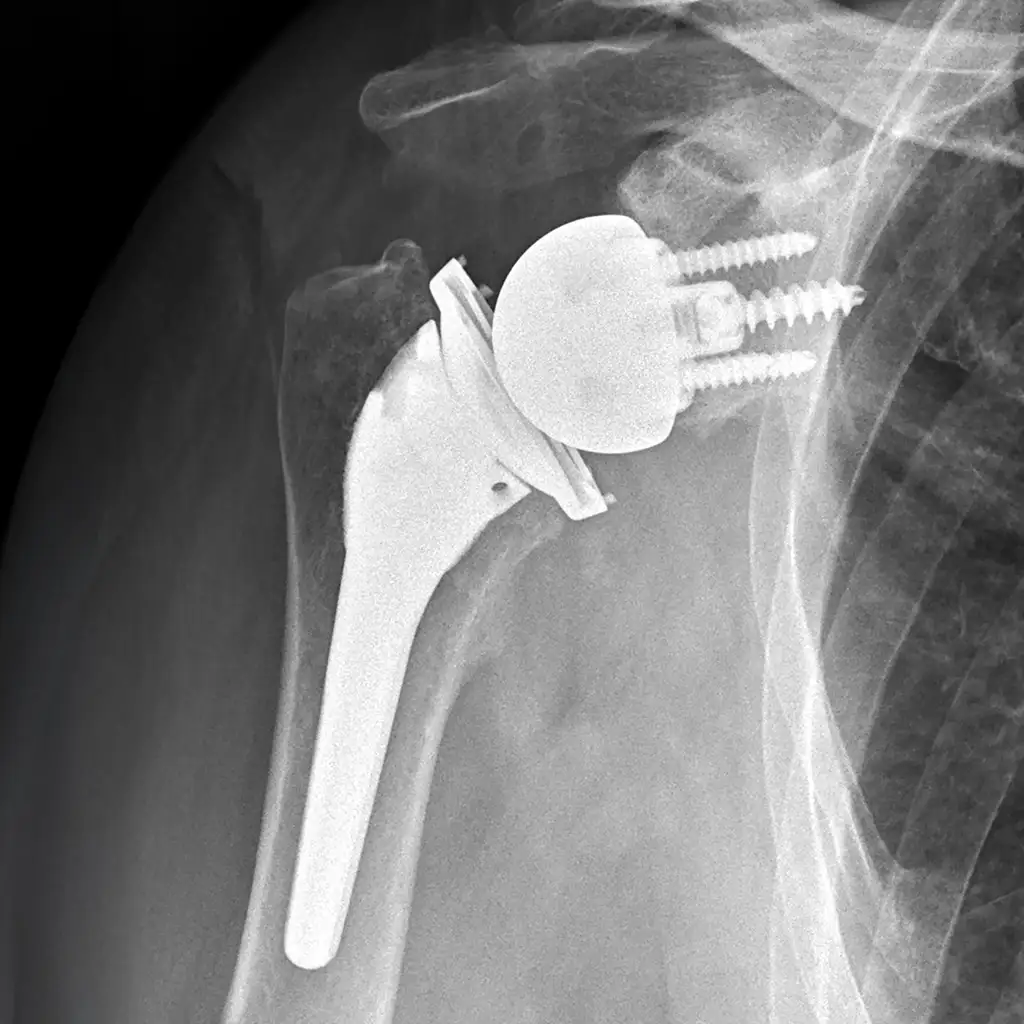 Reverse Shoulder Replacement X-ray