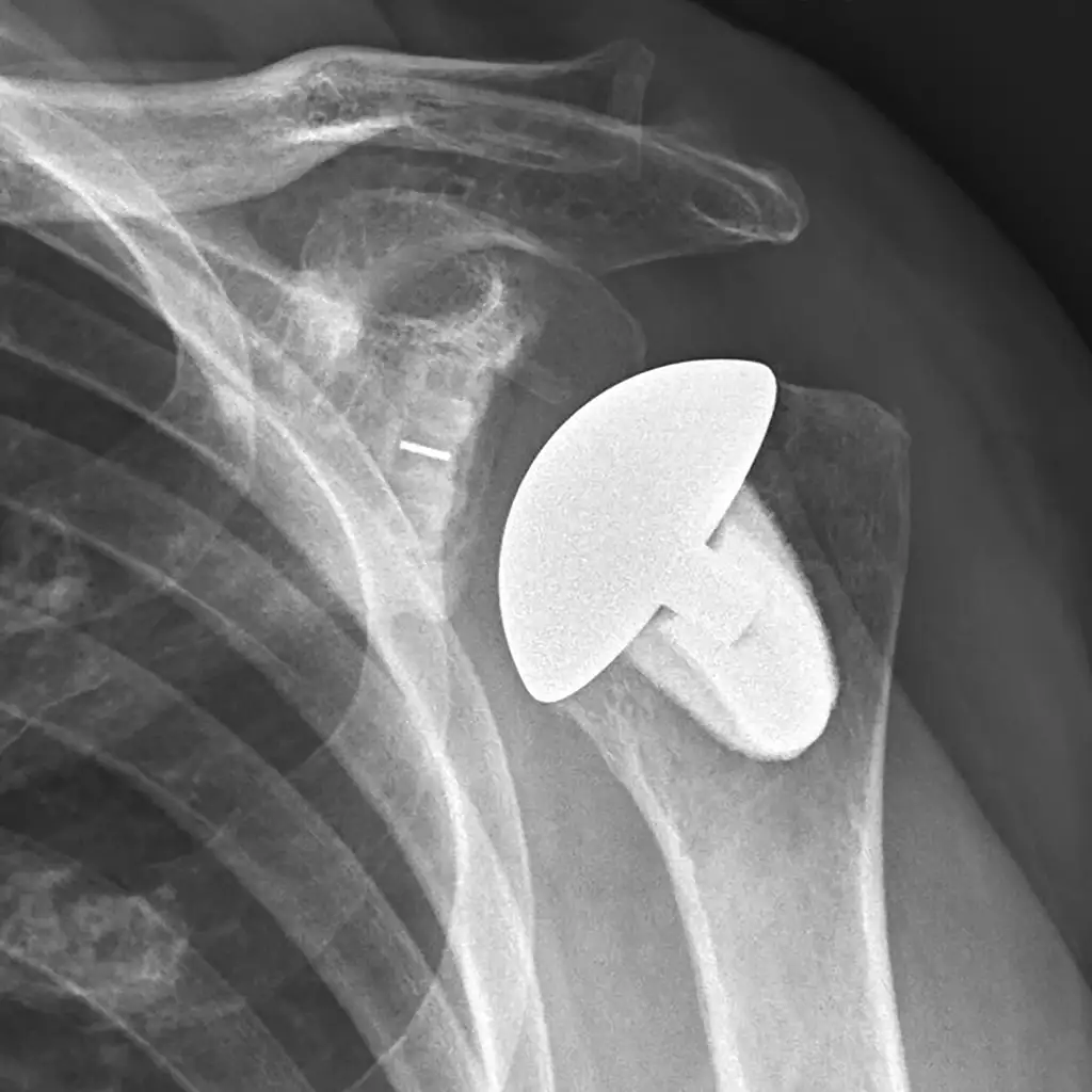 Total Shoulder Replacement X-ray