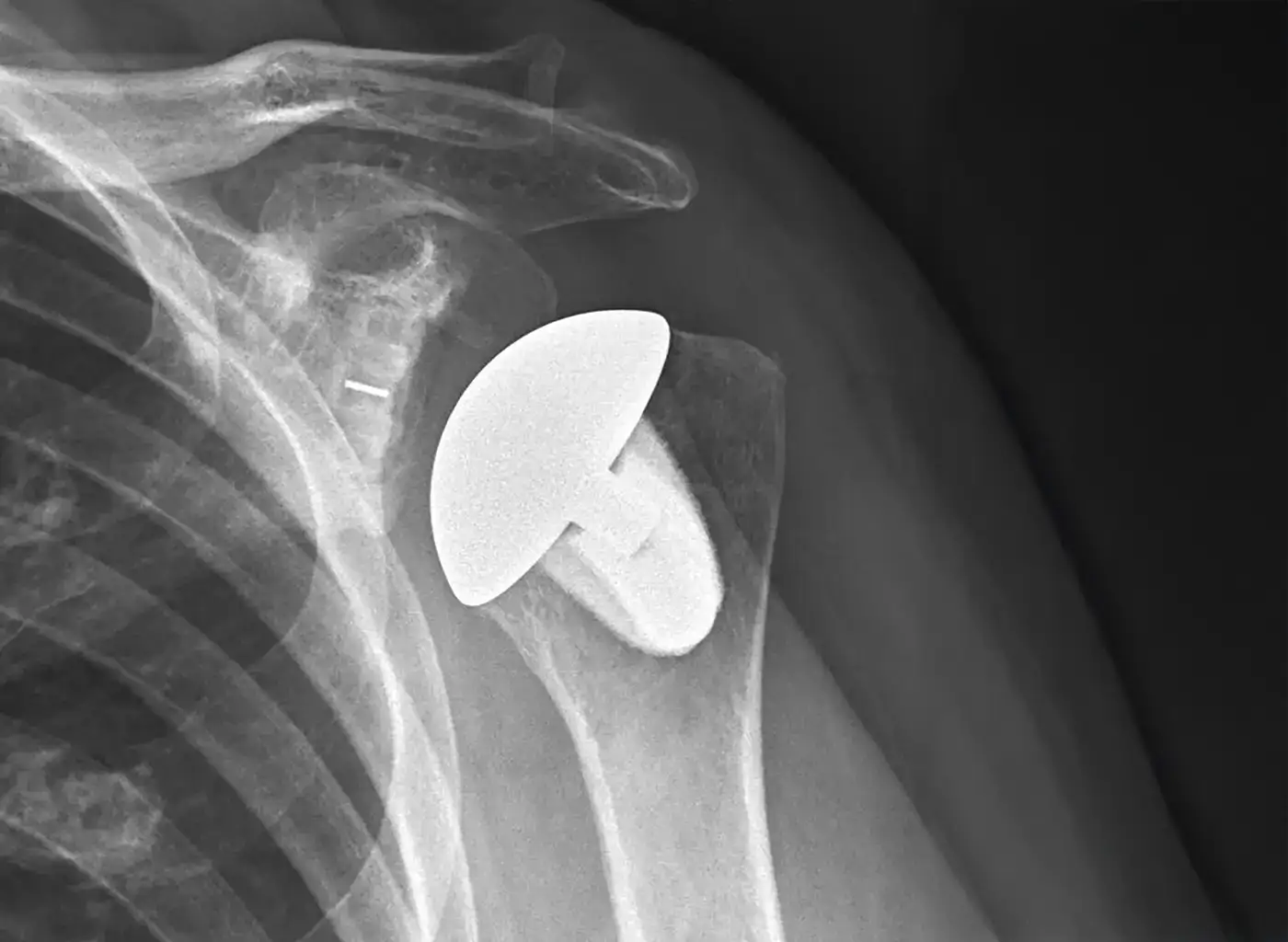 X-ray Total Shoulder Replacement