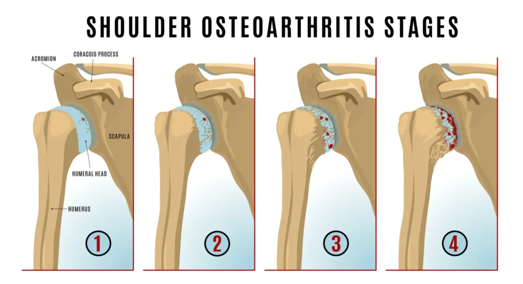 Stages of osteoarthritis in the shoulder