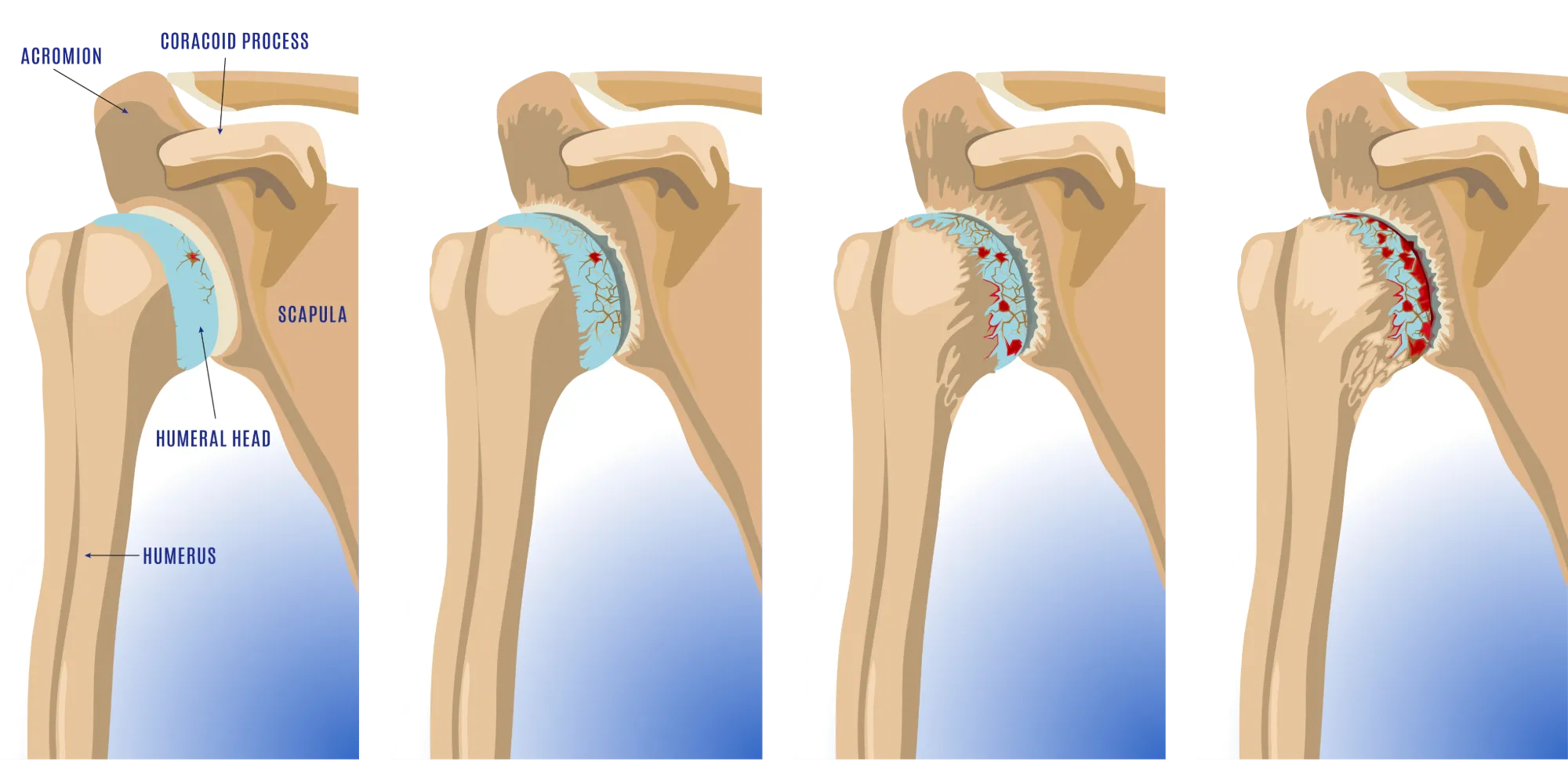 Shoulder Arthritis progression diagram