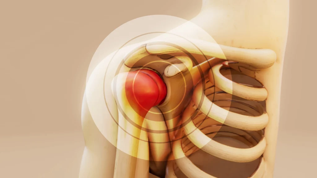 Rheumatoid Arthritis found in the shoulder joint.