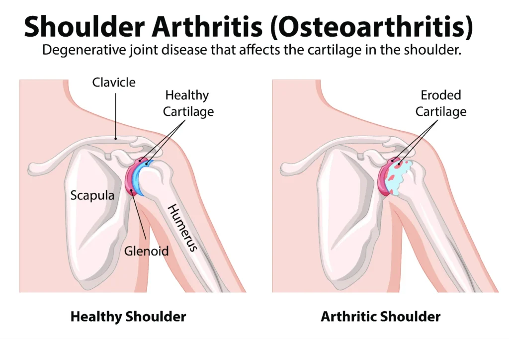shoulder arthritis diagram, showing the difference between a healthy and arthritic shoulder.