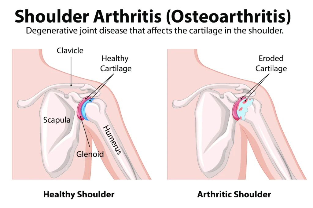 shoulder arthritis diagram, showing the difference between a healthy and arthritic shoulder.