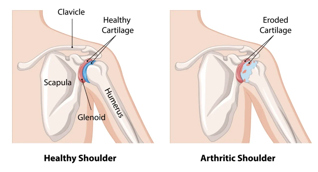shoulder arthritis diagram comparing a healthy and arthritic shoulder
