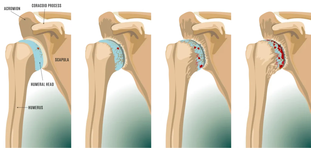 Progression of shoulder arthritis. 