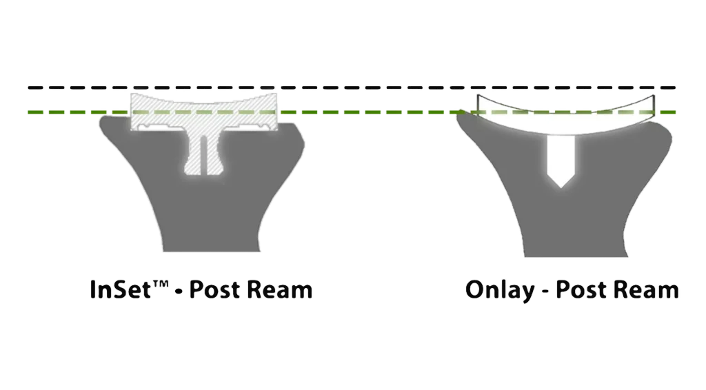 InSet® vs onlay glenoid diagram